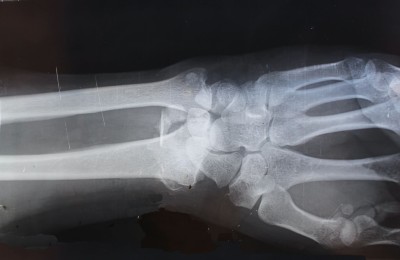 The Ultimate Guide to Personal Injury Law!